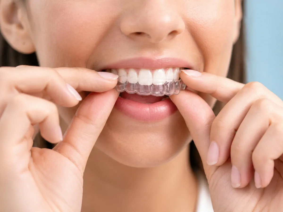 Aligner-Therapie – unsichtbare Zahnkorrektur – Zahnarztpraxis Freienstein