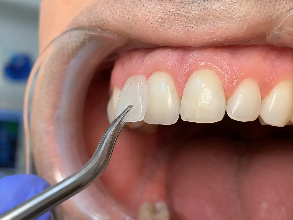 Non-Prep-Veneers – schöne Zähne ohne Schleifen – Zahnarztpraxis Freienstein